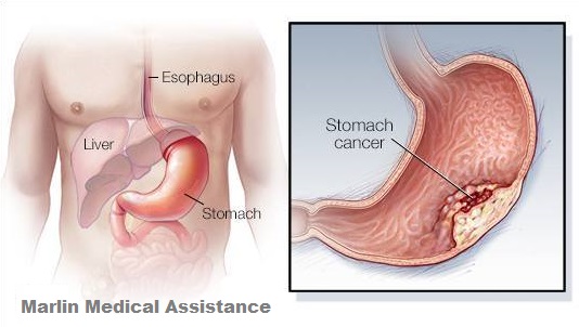 Stomach cancer surgery in India | stomach cancer treatment in India