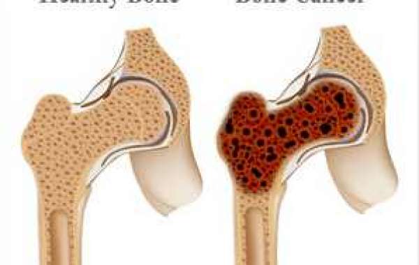 Blood Cancer treatment in India | Blood cancer treatment in Delhi