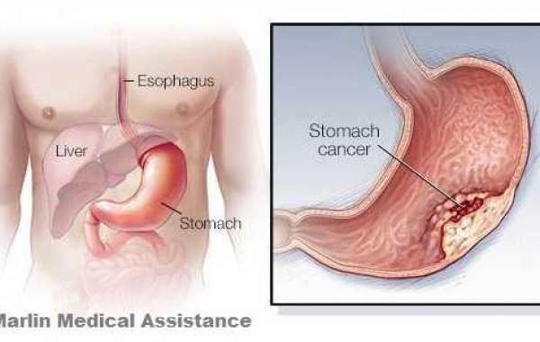 Stomach cancer surgery in India | stomach cancer treatment in India