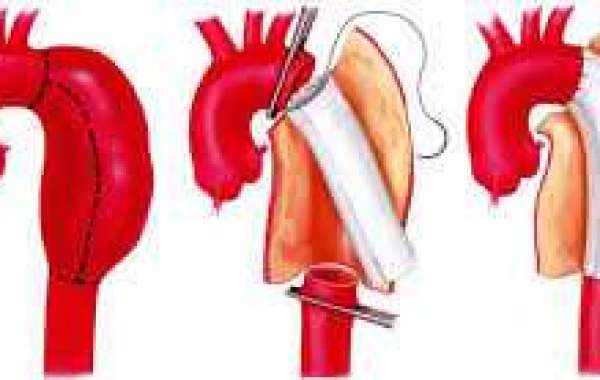 Aortic Stent Grafting treatment in India