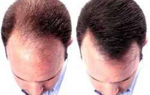 Hair Transplant in Karachi: The Link Between Hair Health and Scalp Care