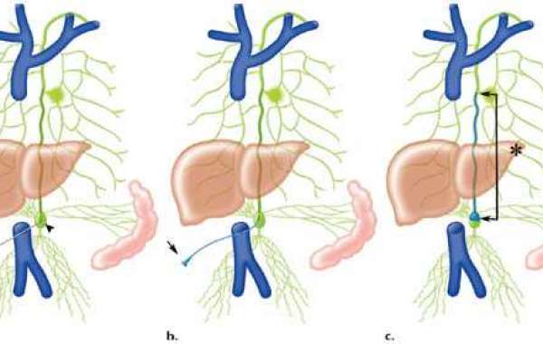 Lymphangiography Treatment In India
