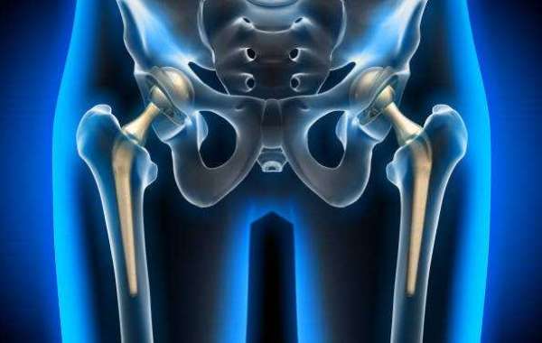 Leading Hip Replacement Specialists in Nagpur by Gadge Hospital